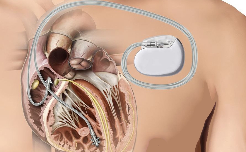 Життя з кардіостимулятором: поради пацієнтам та відповіді на найпоширеніші питання